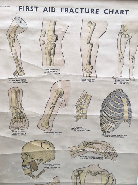 Original Cool vintage “ first and fracture chart medical poster